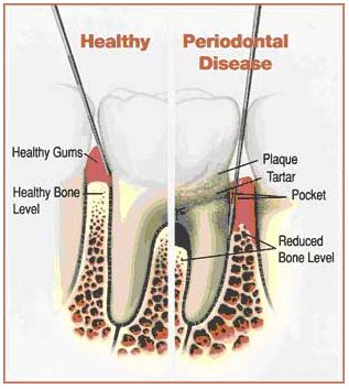 Kennesaw Periodontal Disease Treatment