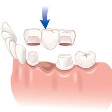 Marietta Dentists For Crowns/Bridges