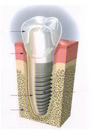 implant