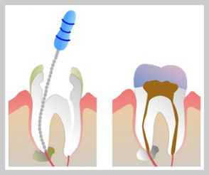 Kennesaw Root Canals