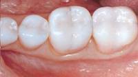 Kennesaw Dental Fillings