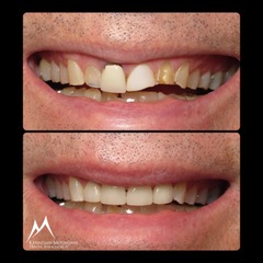  crown case before and after photo of a patiens smile