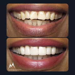 veener case before and after photo of a patiens smile