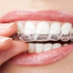 Clear Aligners